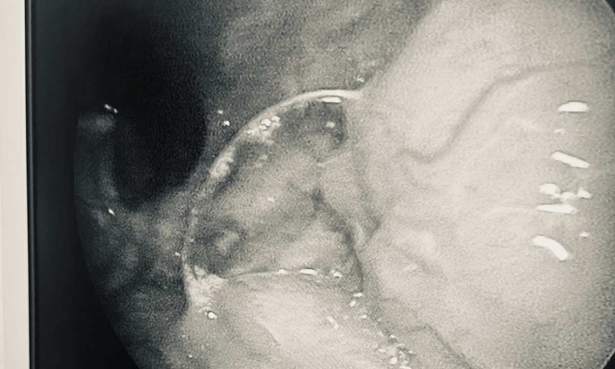 Risk in Vietnamese Street Food: Pig Bristle Found Lodged in Patient's Tonsil