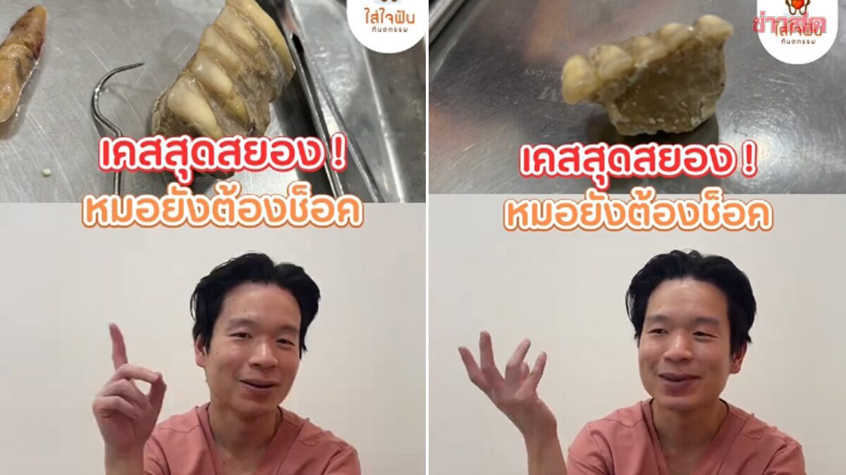 歯石で連結し総入れ歯のように脱落した衝撃の症例、タイの歯科医がSNSで警鐘