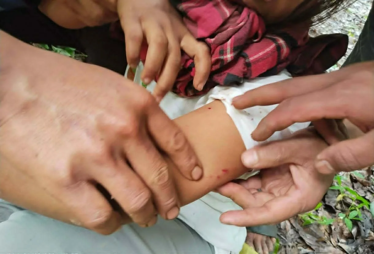 Displaced Woman Injured by Artillery Shrapnel While Returning from Upland Farm in Eastern Hpruso