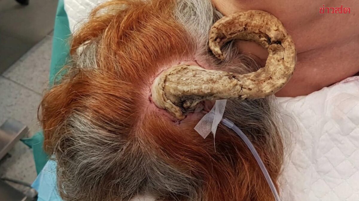 後頭部に26cmの「角」が生えた75歳女性、正体は皮膚がんだった