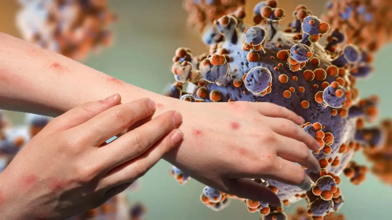 Thailand on High Alert Over New Mpox Clade Ib Cases