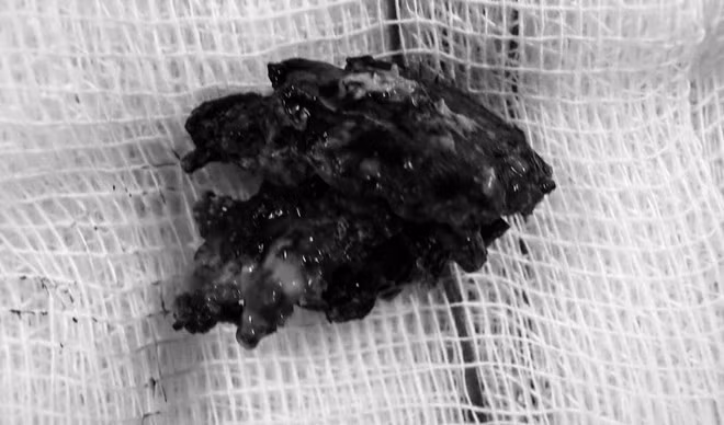Decades-Old Foreign Object Removed from Patient's Nasal Cavity in Quang Tri