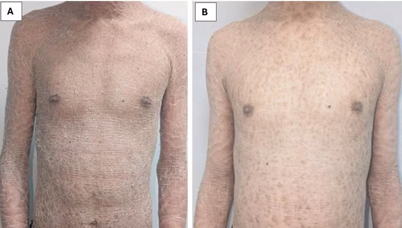 Children with Ichthyosis Hospitalized Due to Improper Skin Care