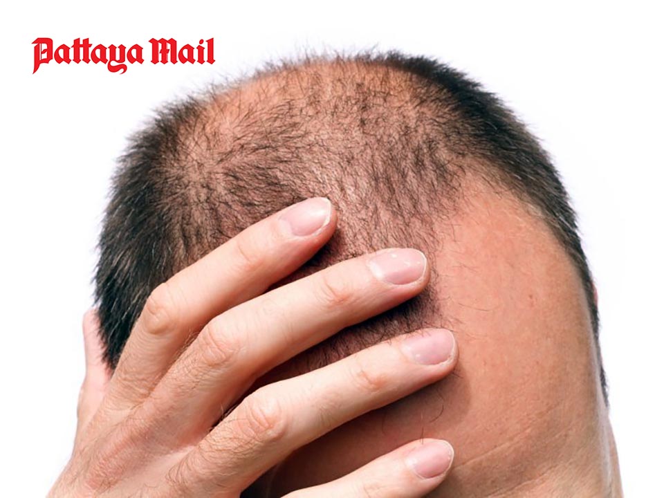 Could My Hair Loss be Down to Andropause? Pattaya Men Seek Answers