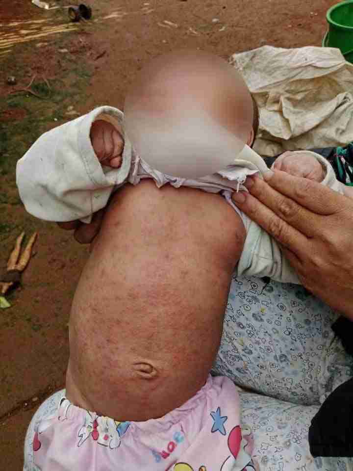 2-month-old infant with full-body rash needs assistance to continue medical treatment