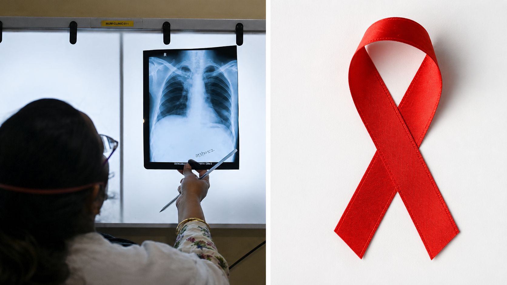 日米、HIV・結核対策強化で420億円規模の連携