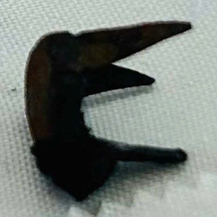 12-year-old boy recovers after removal of rusted foreign object from lung