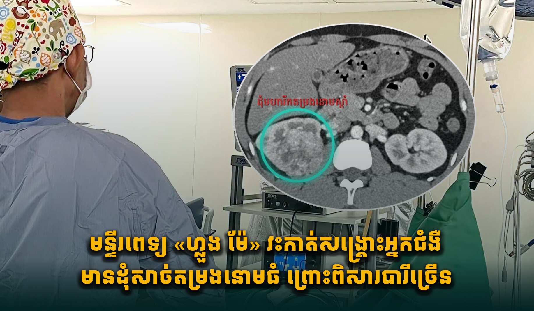 喫煙多用の36歳男性、腎臓腫瘍摘出で一命取り留める