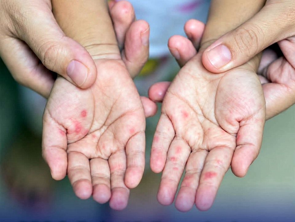 Thailand Records Over 53,000 Hand, Foot, and Mouth Disease Cases, One Death This Year