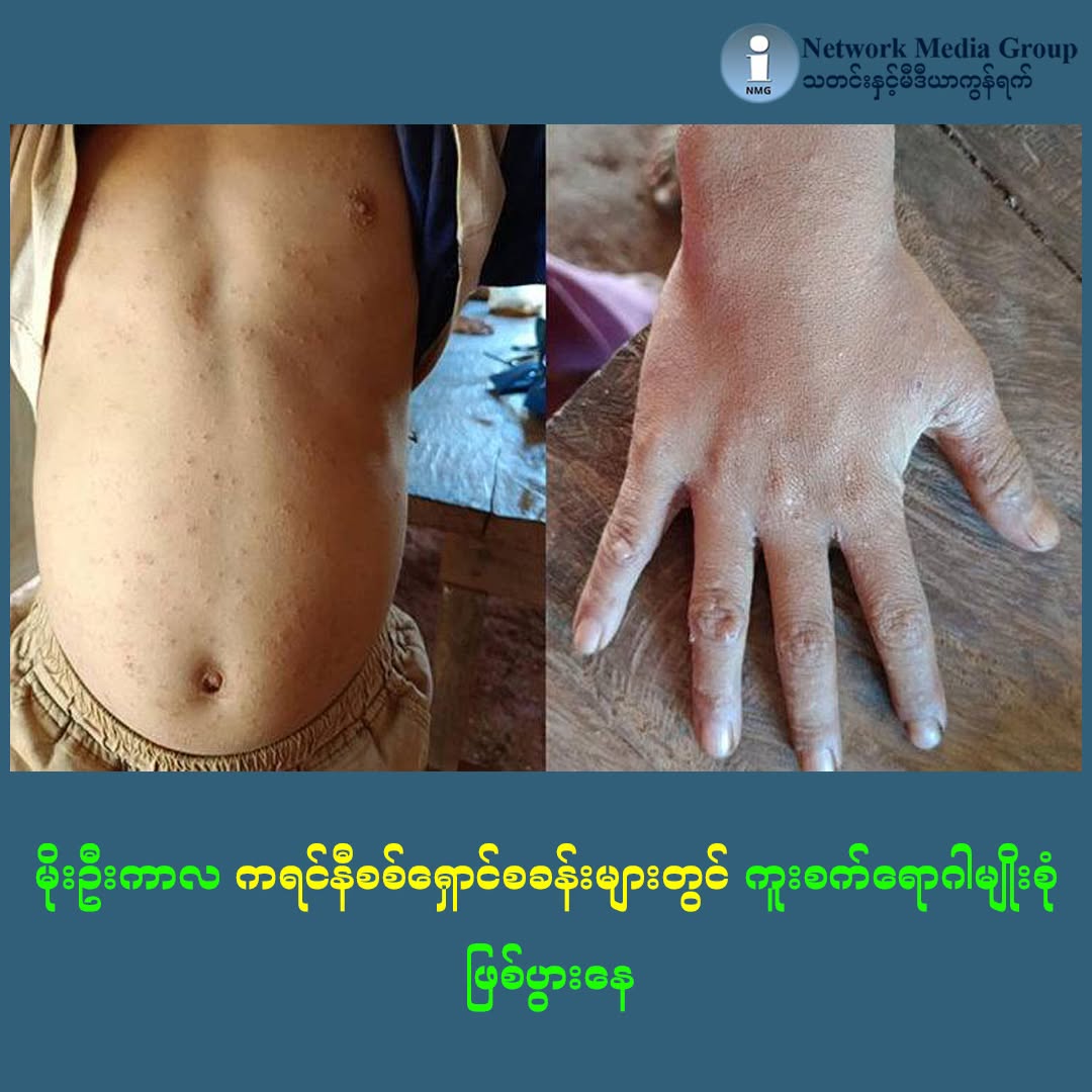 Multiple infectious diseases spread in IDP camps in Karenni State at onset of rainy season